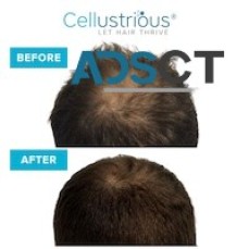 BRADENTON, FL: HAIR LOSS SPECIALIST, HAIR LOSS SOLUTION LAKEWOOD RANCH, FL