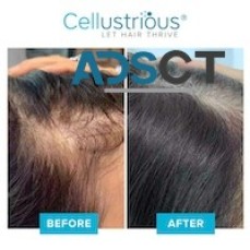 BRADENTON, FL: HAIR LOSS SPECIALIST, HAIR LOSS SOLUTION LAKEWOOD RANCH, FL