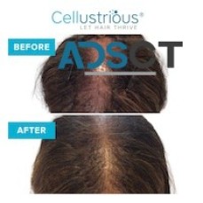 BRADENTON, FL: HAIR LOSS SPECIALIST, HAIR LOSS SOLUTION LAKEWOOD RANCH, FL